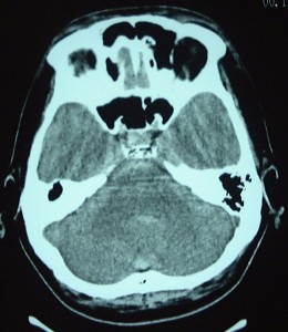VAdissectionCT1